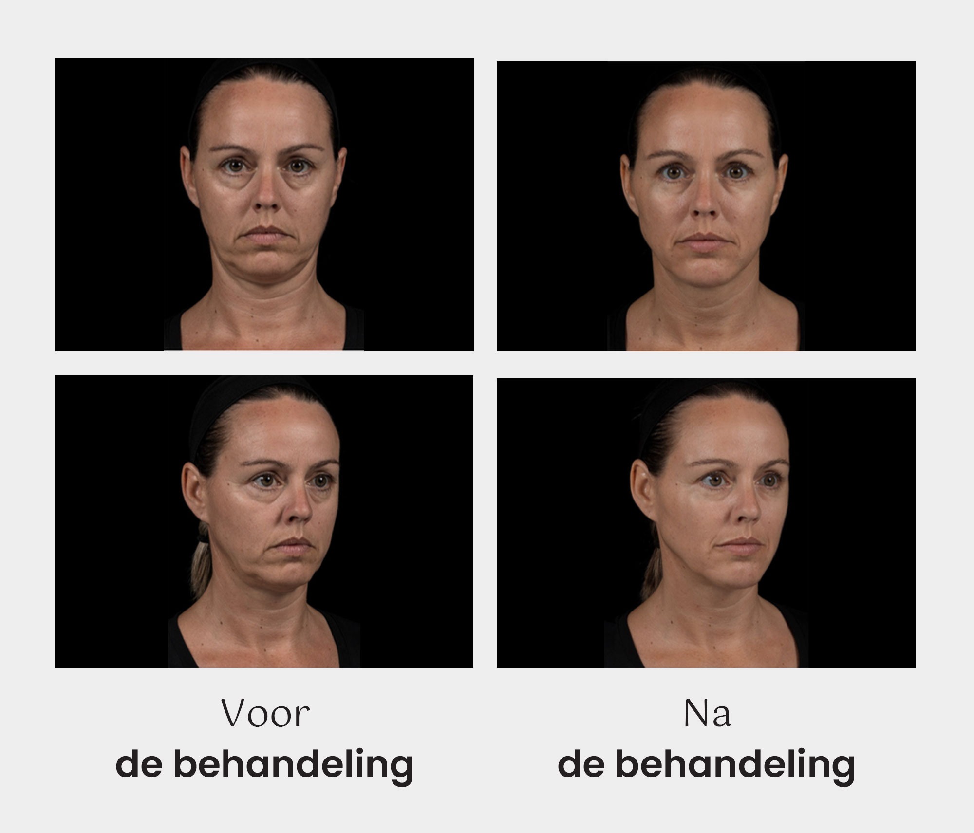 Liquid Facelift - before & after